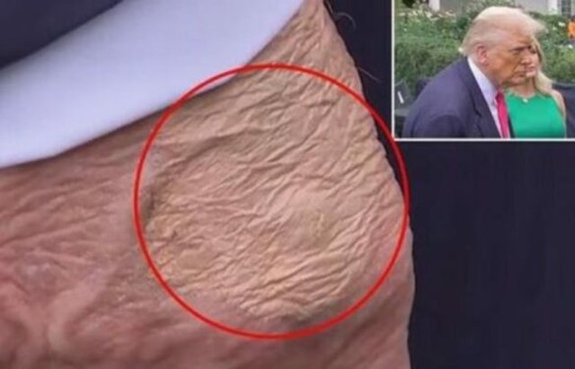Disa shenja shfaqen në dorën e Trumpit, ekspertët zbulojnë se çfarë janë ato në të vërtetë