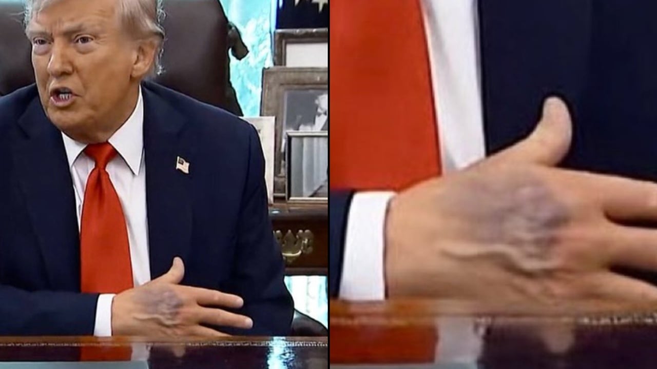Dora e nxirë e Trump bën xhiron e rrjetit, Shtëpia e Bardhë sqaron çfarë i ka ndodhur Presidentit amerikan